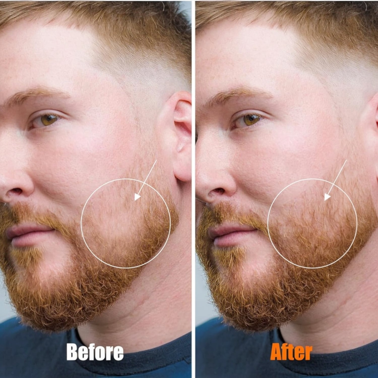 Derma Roller