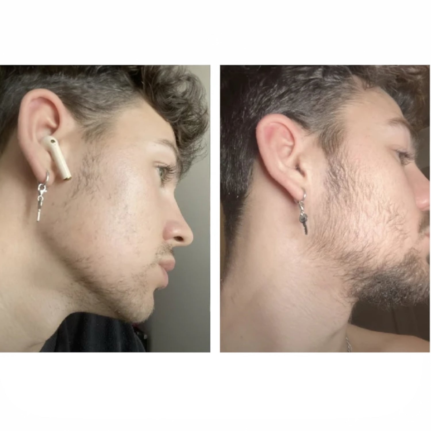 Derma Roller